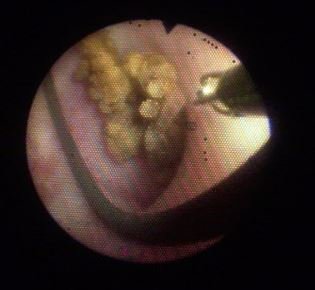 Eine endoskopische Aufnahme eines Nierensteins.