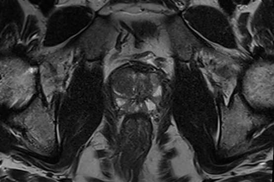 Eine Aufnahme aus der Prostata-MRT