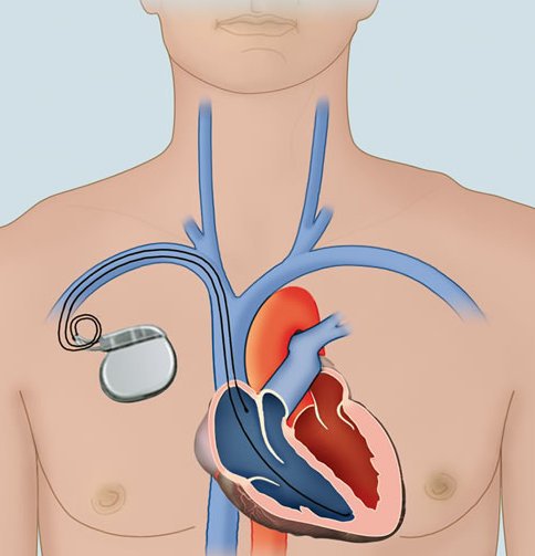 Herzschrittmacher