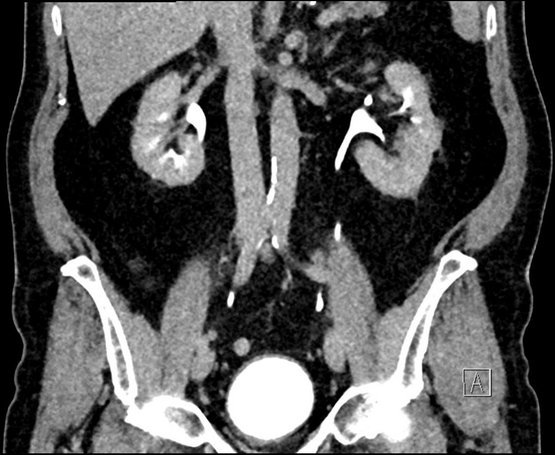 Eine CT-Aufnahme einer Harnblase.