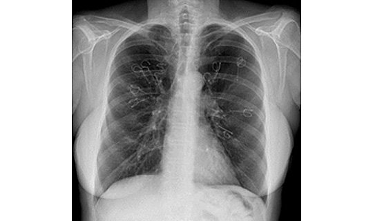 Röntgenaufnahme nach Volumenreduktion beider Lungen mit Coils