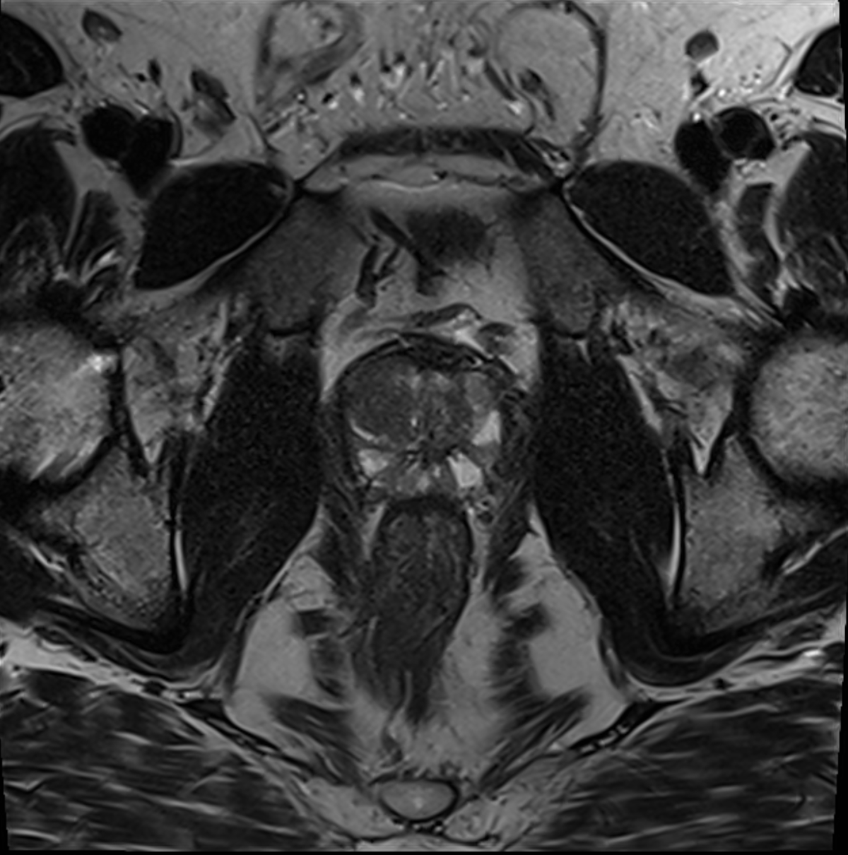 Prostata-MRT und Prostata-Biopsie im Institut für Radiologie im Krankenhaus Martha-Maria Nürnberg Prostata-MRT und Prostata-Biopsie im Institut für Radiologie im Krankenhaus Martha-Maria Nürnberg
