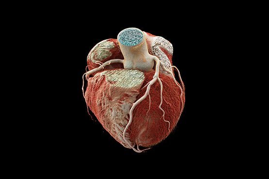 3D- Aufnahme aus der Herz-Computertomografie