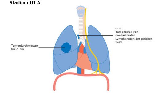 Lungenbiopsie Wie Lange Im Krankenhaus kh-muenchen.martha-maria.de