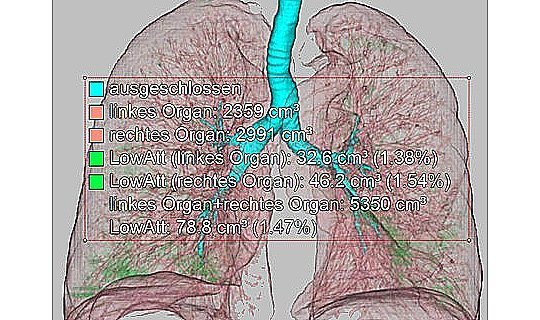 Computergestütze Darstellung der Emphysemverteilung: Gesunde Lunge