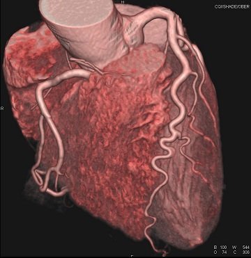 Cardio CT