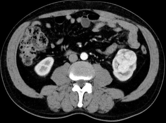 Eine CT-Aufnahme eines Nierentumors.