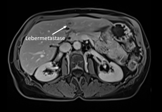 Darstellung einer kleinen Lebermetastase mittels Leber-MRT in der Radiologie Nürnberg.