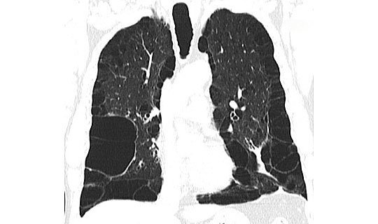 CT-Aufnahme eines schweren Lungenemphysems mit großen Emphysemblasen