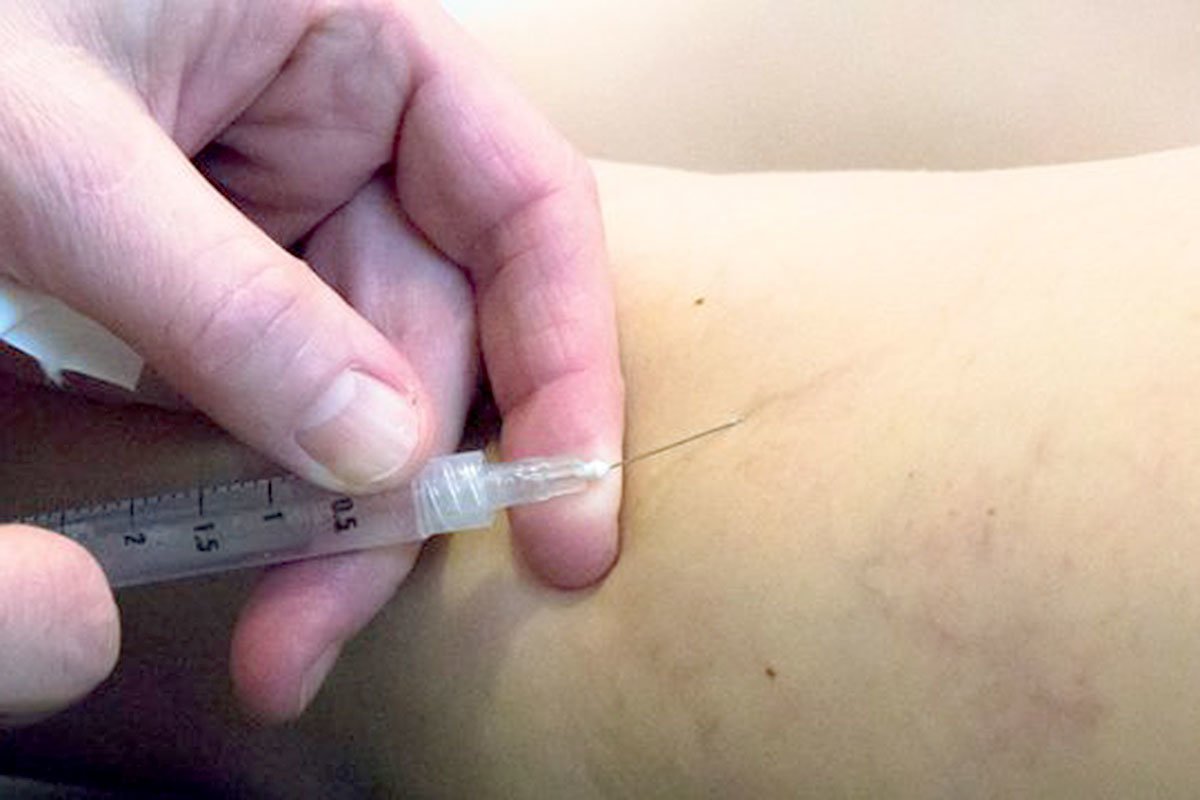 Verödungstherapie im MVZ Martha-Maria Gefäßchirurgie Nürnberg Verödungstherapie