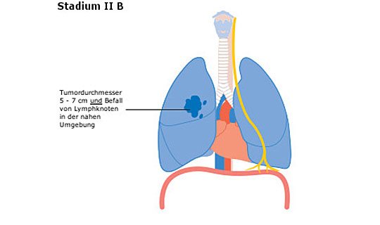 Diagramm der Lunge mit Tumor in Stadium II B, Lymphknotenbefall.