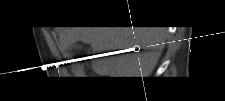 CT-gesteuerte Nadel zur minimalinvasiven interventionellen Radiologie im Krankenhaus.