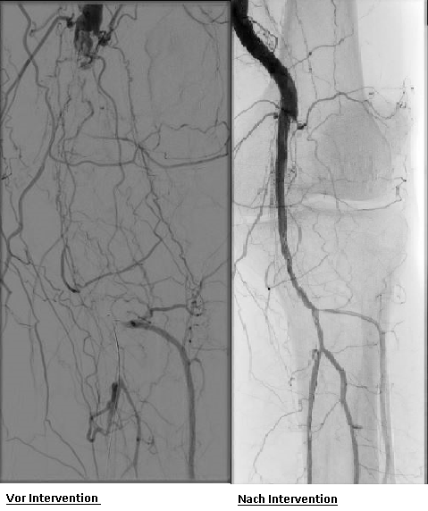 Angiologie vorher nachher