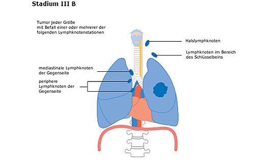 Diagramm der Lunge mit Tumor in Stadium III B, Lymphknotenbefall dargestellt.