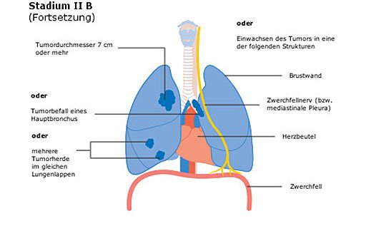 Diagramm der Lunge mit Tumor in Stadium II B, zeigt betroffene Strukturen.