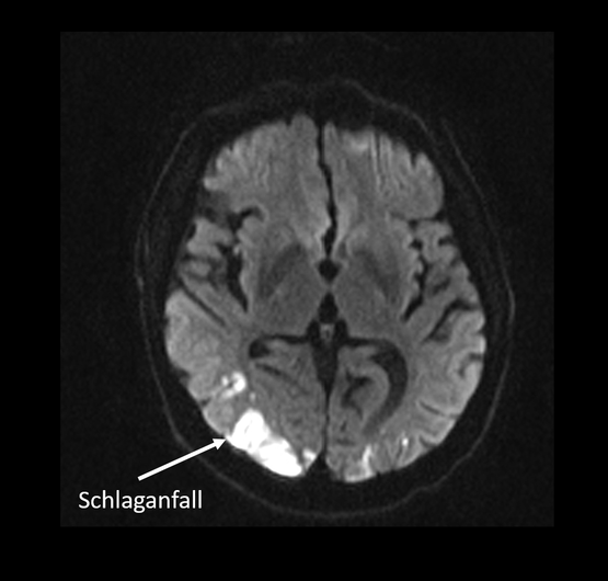 MRT-Bild eines Gehirnschlags mit markierter Schlaganfallregion in der Radiologie Nürnberg.