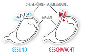 Diagramm zeigt gesunden und geschwächten Speiseröhren-Schließmuskel bei Reflux.