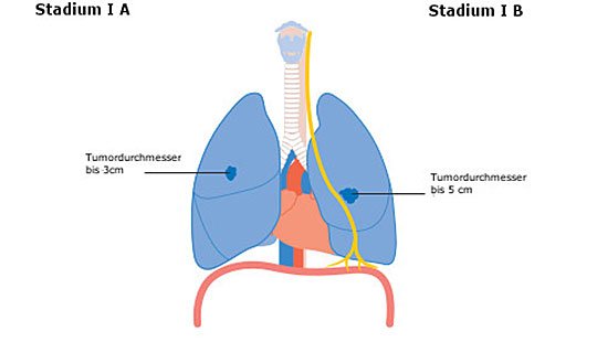 Diagramm der Tumorstadien I A und I B in der Lunge.