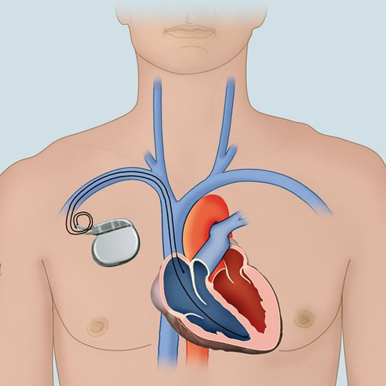 Herzschrittmacher