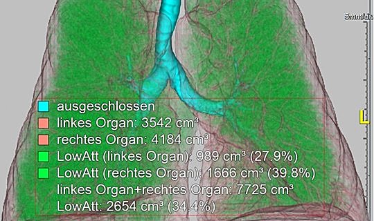 Gleichmäßig verteiltes Emphysem (Emphysemanteil ist grün dargestellt)