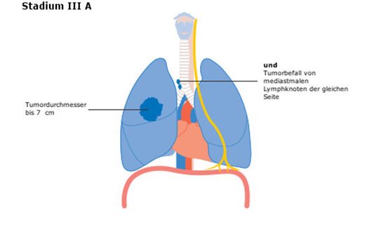 Diagramm der Lunge mit Tumor in Stadium III A, zeigt betroffene Strukturen.