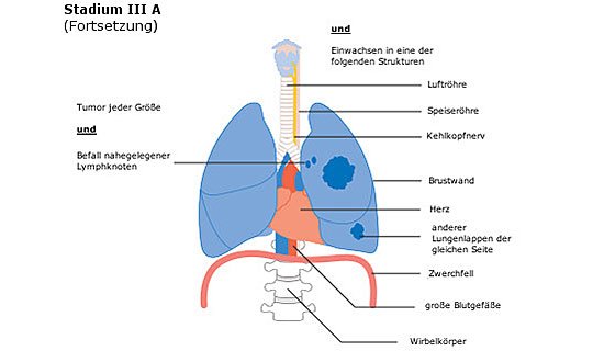 Diagramm der Lunge mit Tumor in Stadium III A, anatomische Strukturen markiert.