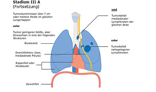 Diagramm der Lunge mit Tumor in Stadium III A, zeigt betroffene Strukturen.