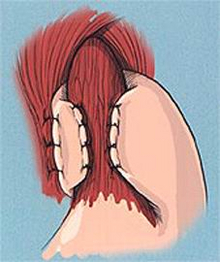 Illustration einer Fundoplicatio-Operation zur Behandlung von Refluxkrankheit.