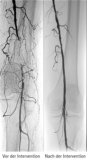 Röntgenbilder einer Beinarterie vor und nach einer Intervention zur Behandlung von Gefäßverengungen.
