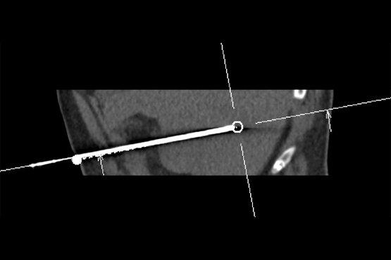 CT-Biopsie und Mikrowellenablation