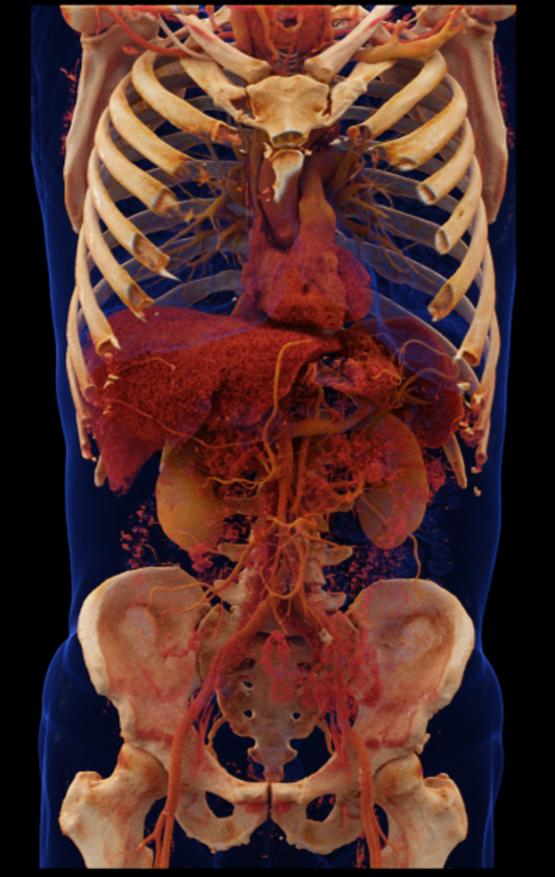 3D-CT-Aufnahme von Brustkorb und Bauchraum in der Radiologie Nürnberg