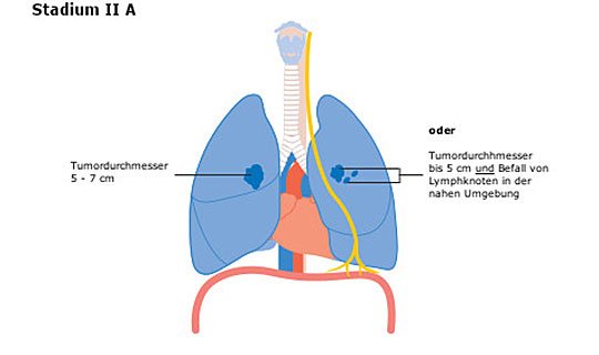 Diagramm der Lunge mit Tumor in Stadium II A, zeigt Tumordurchmesser und Lymphknotenbefall.