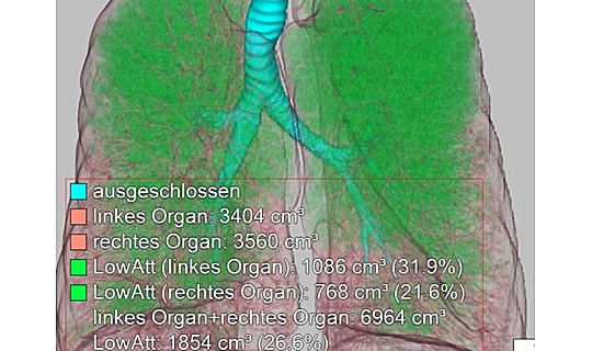 Oberlappenbetontes Emphysem (das Emphysem ist grün dargestellt)