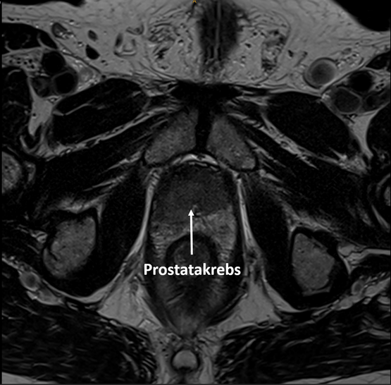 MRT-Bild zeigt Prostatakrebs in der Radiologie Nürnberg.