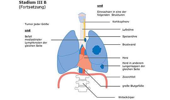 Diagramm der Lunge mit Tumor in Stadium III B, zeigt betroffene Strukturen.