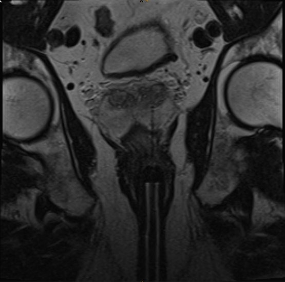 MRT-Bild eines Prostatakarzinoms in der Radiologie Nürnberg.